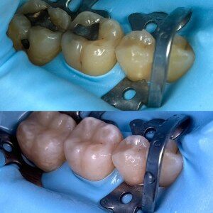 Silver Filling Replacement before and after at M Dental