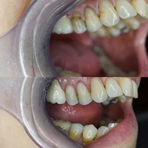 Back Teeth Restoration before and after at M Dental