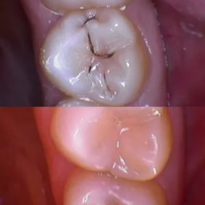 Back Teeth Restoration before and after at M Dental