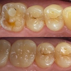 Back Teeth Restoration before and after at M Dental