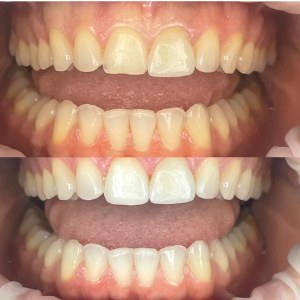 Composite Bonding before and after at M Dental
