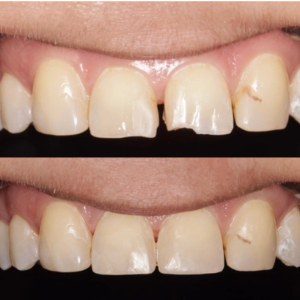 Composite Bonding before and after at M Dental