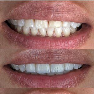 Composite Bonding before and after at M Dental