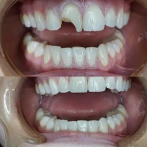 Composite Restorations in One Visit before and after at M Dental