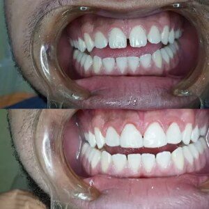 Composite Restorations in One Visit before and after at M Dental