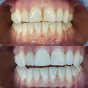 Composite Restorations in One Visit before and after at M Dental