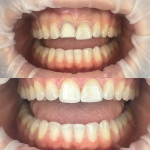 Composite Restorations in One Visit before and after at M Dental