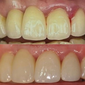 Crown Replacement before and after at M Dental