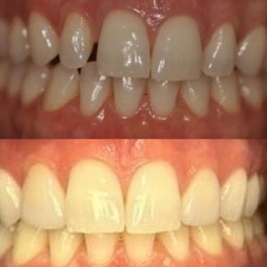 Front Tooth Crown before and after at M Dental