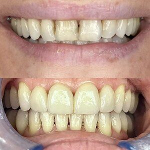 Front Tooth Restoration before and after at M Dental