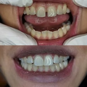 Front Tooth Restoration before and after at M Dental
