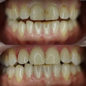 Front Tooth Restoration before and after at M Dental