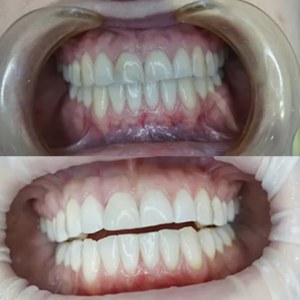 Front Tooth Restoration before and after at M Dental