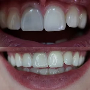 Internal Whitening before and after at M Dental
