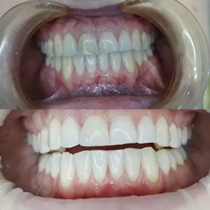 Internal Whitening before and after at M Dental