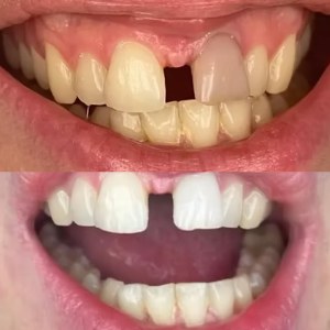 Internal Whitening before and after at M Dental