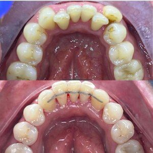 Orthodontic Treatment before and after at M Dental