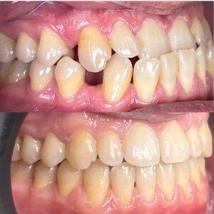 Orthodontic Treatment before and after at M Dental