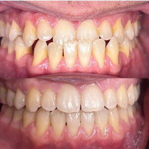 Orthodontic Treatment before and after at M Dental