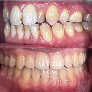 Orthodontic Treatment before and after at M Dental
