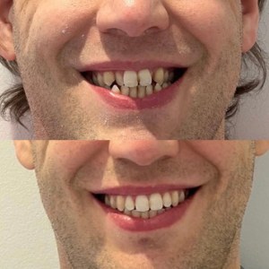 Orthodontic Treatment before and after at M Dental