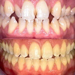 Orthodontic Treatment before and after at M Dental