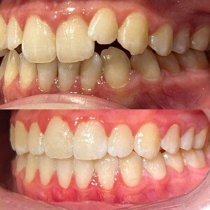 Orthodontic Treatment before and after at M Dental