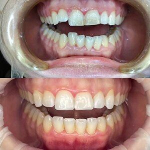 Orthodontics & Composite before and after at M Dental