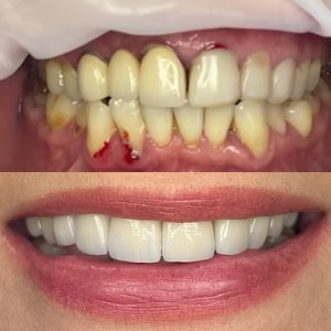 Smile Makeover before and after at M Dental