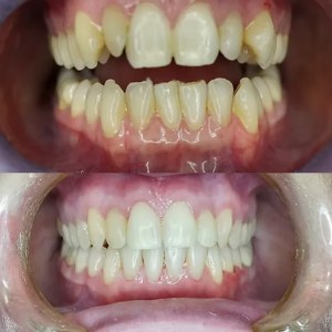Smile Makeover before and after at M Dental