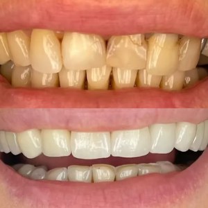 Smile Makeover before and after at M Dental
