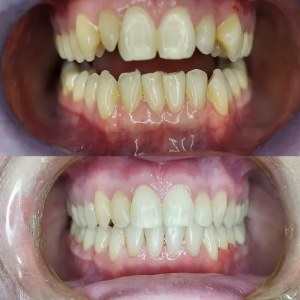 Teeth Straightening before and after at M Dental