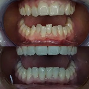 Teeth Straightening before and after at M Dental