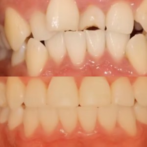 Teeth Straightening before and after at M Dental