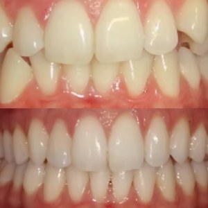 Teeth Straightening before and after at M Dental