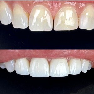 Veneers before and after at M Dental