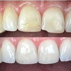 Veneers before and after at M Dental