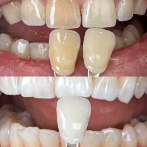 Teeth Whitening before and after at M Dental