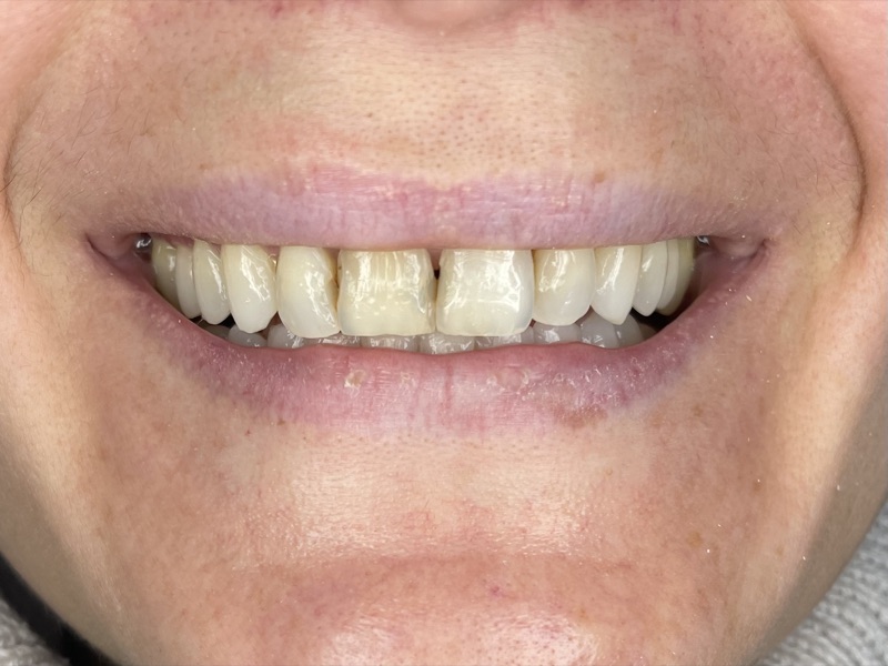 Before-and-after patient smile result at M Dental