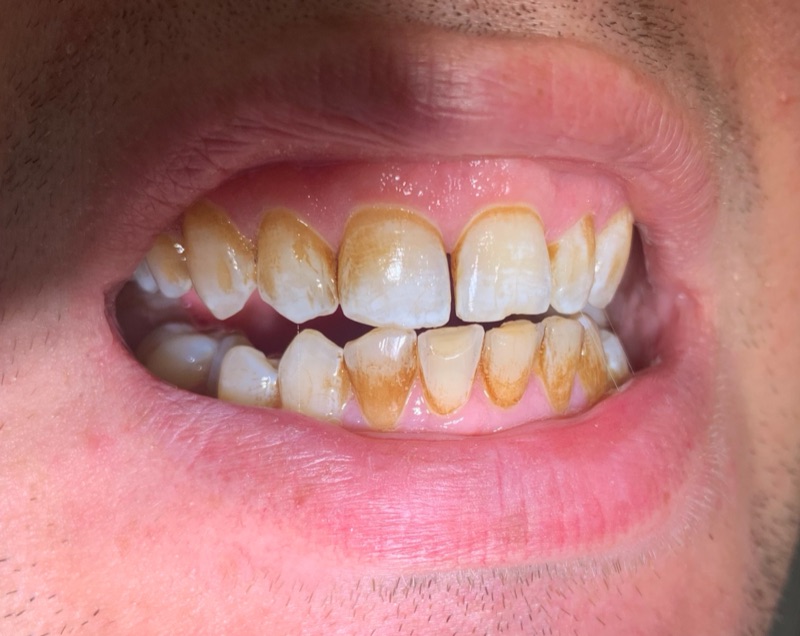 Before-and-after patient smile result at M Dental