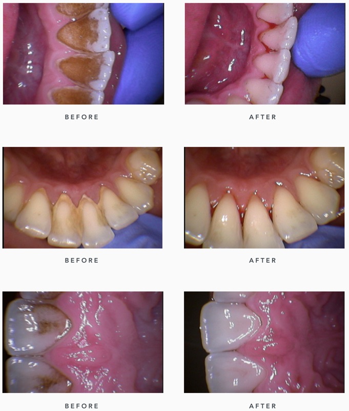 Before-and-after patient smile result at M Dental