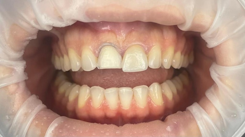 Before-and-after patient smile result at M Dental