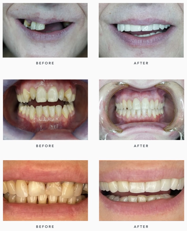 Before-and-after patient smile result at M Dental