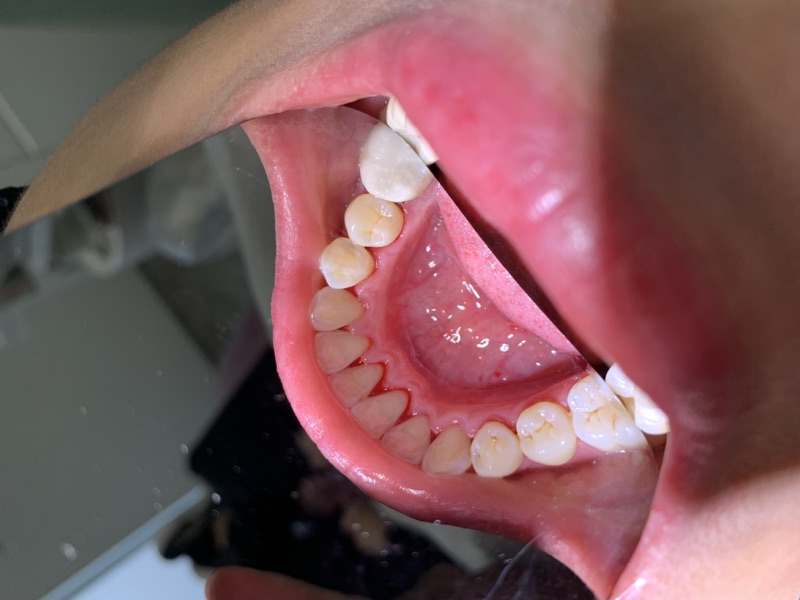 Before-and-after patient smile result at M Dental