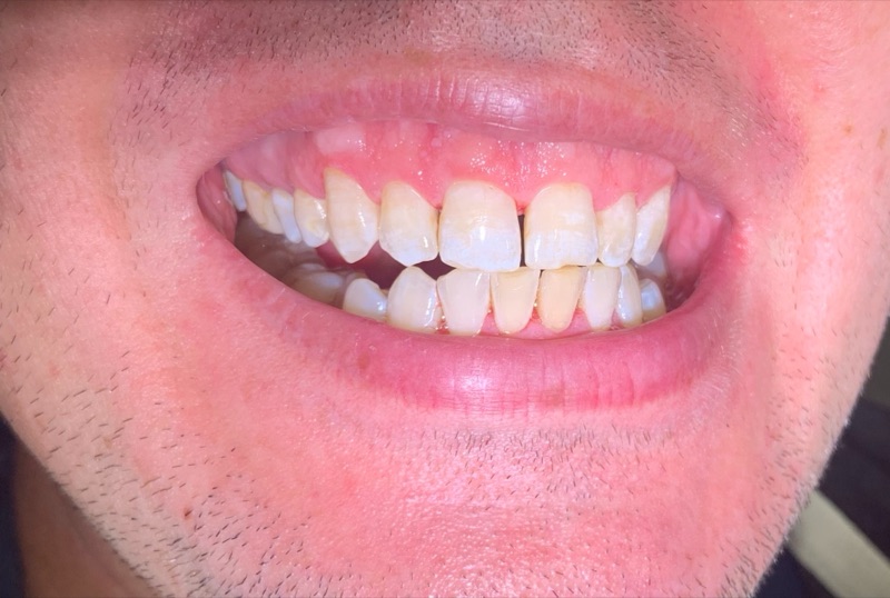 Before-and-after patient smile result at M Dental