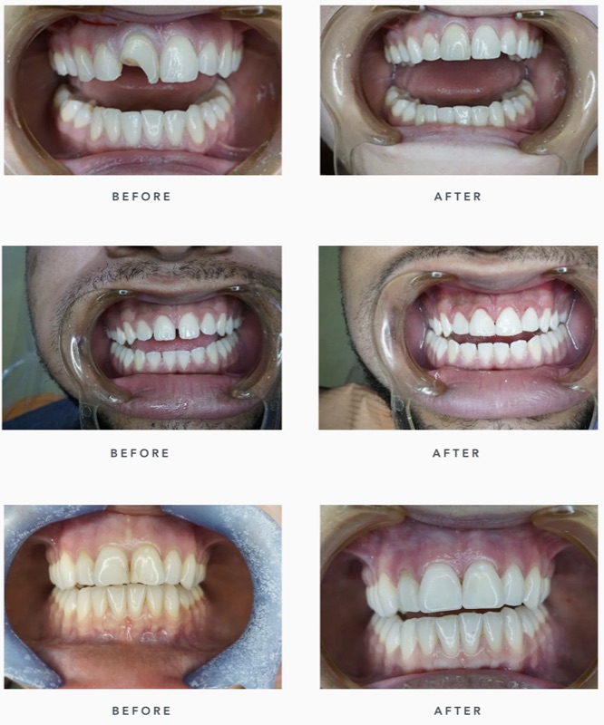 Before-and-after patient smile result at M Dental