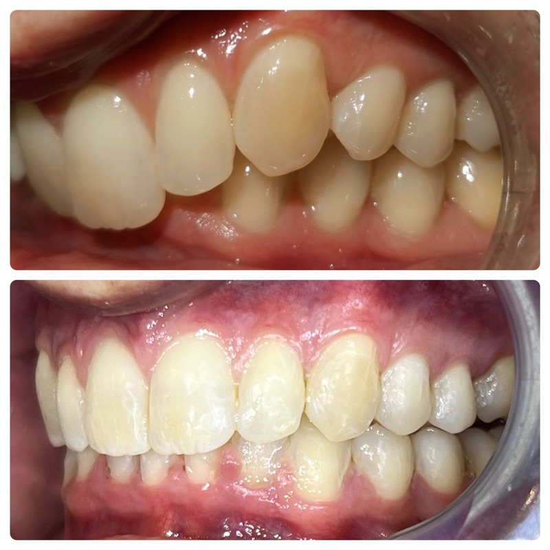 Before-and-after patient smile result at M Dental
