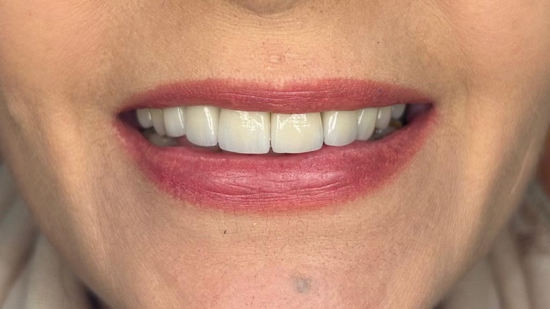 Before-and-after patient smile result at M Dental