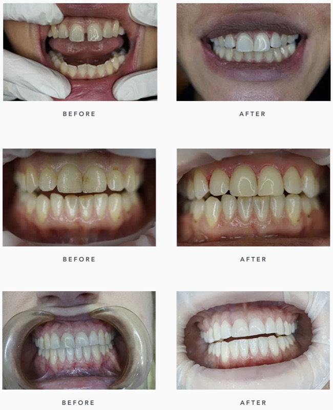 Before-and-after patient smile result at M Dental