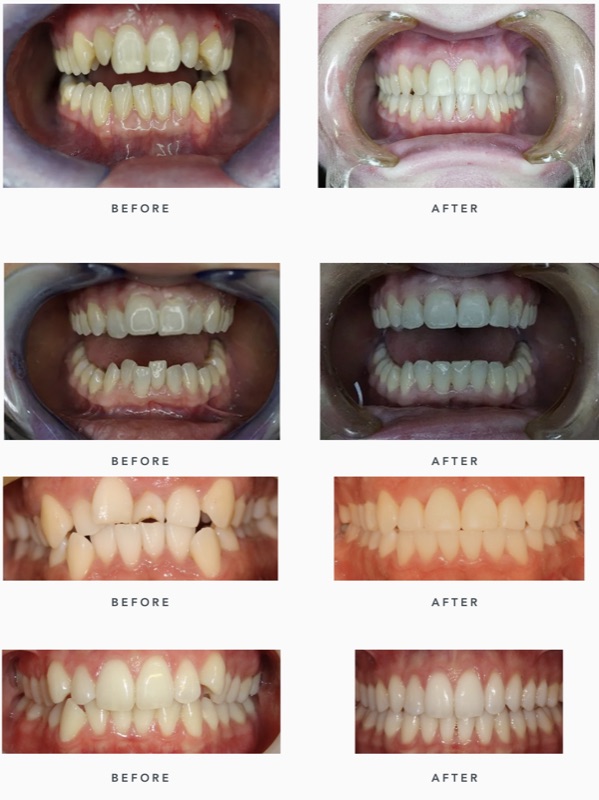 Before-and-after patient smile result at M Dental